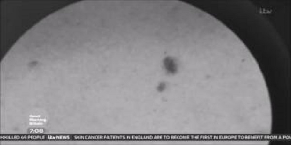 New Skin Cancer Treatment Now Available In England